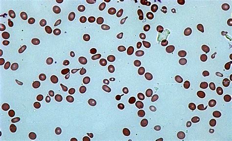 Poikilocytosis: Symptoms, Treatment, Outlook, and More.